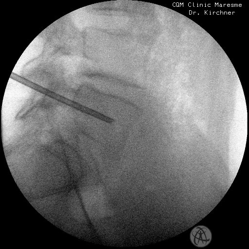  infiltraciones de prp intraóseo